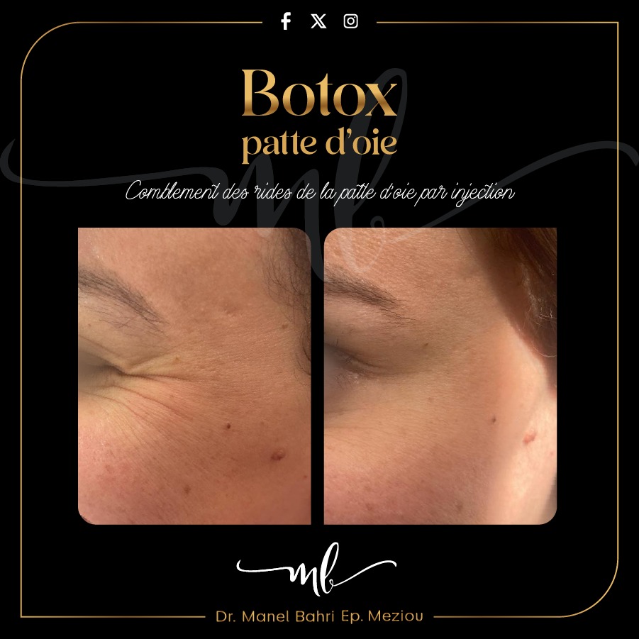 Botox Patte d'oie