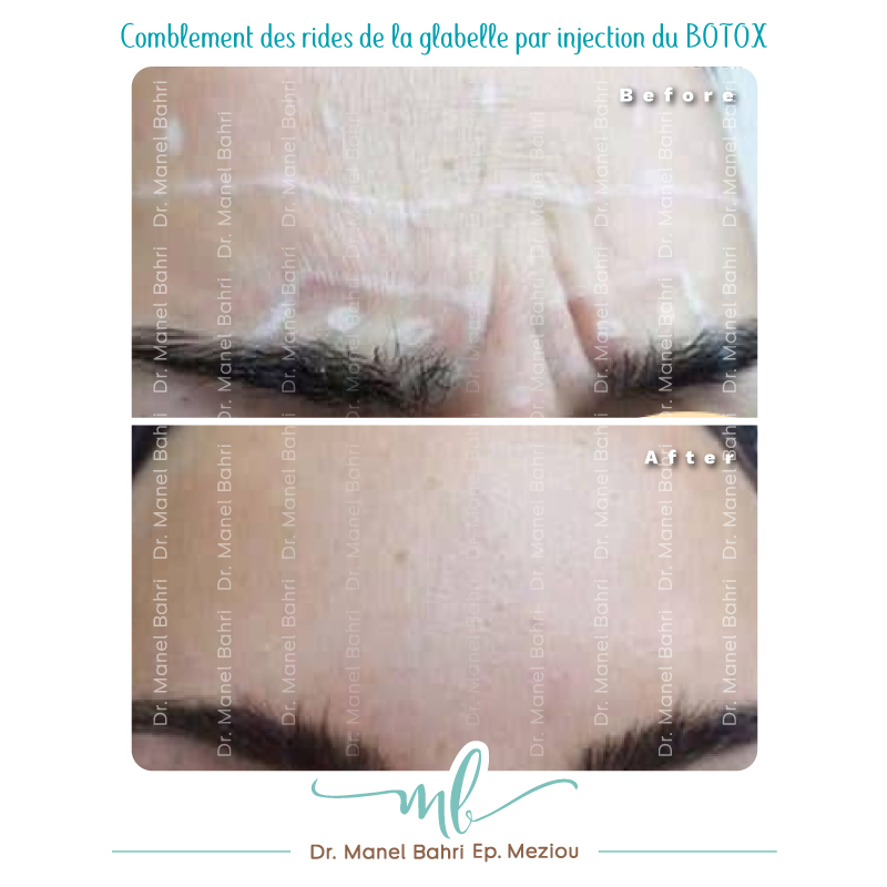 Comblement des rides  de la glabelle par injection Botox