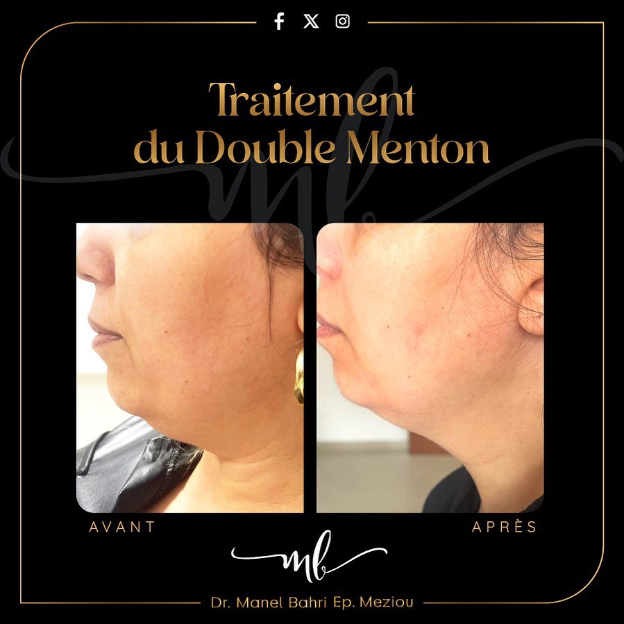 Traitement du double menton