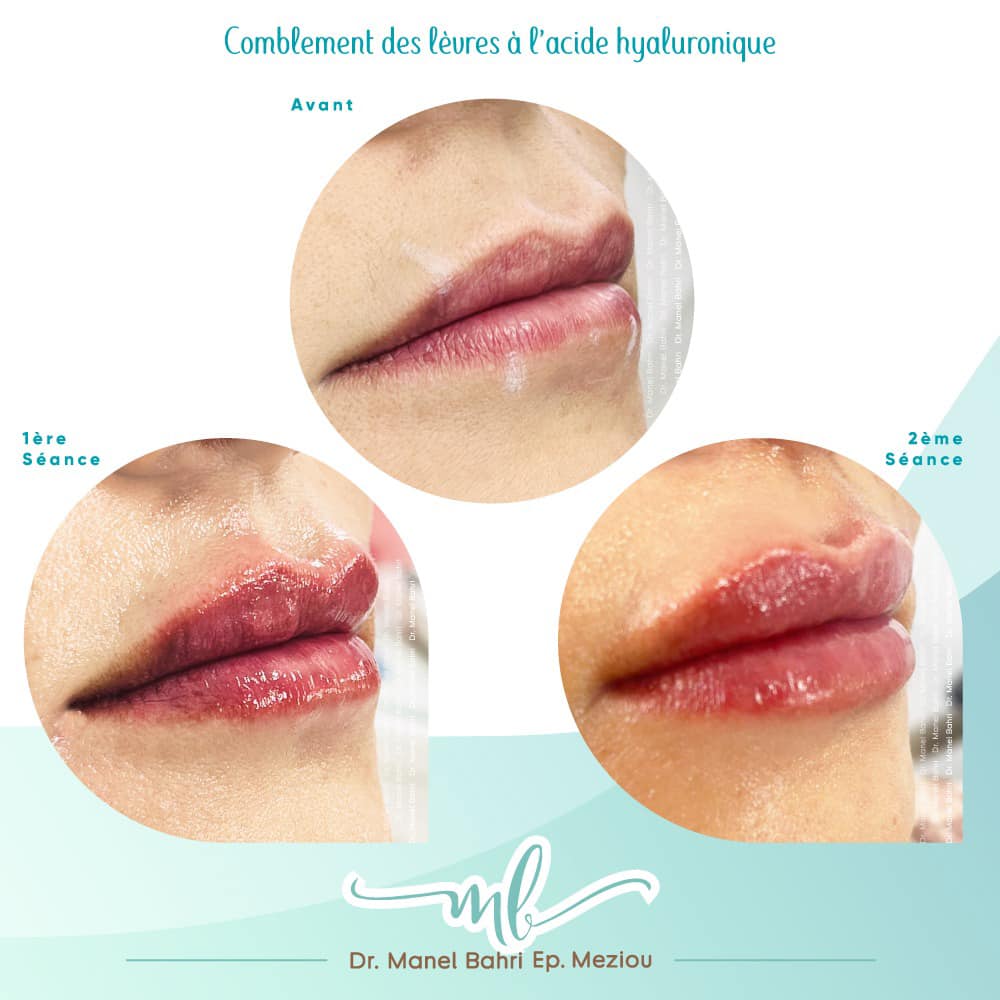 comblement de lèvres à l'acide hyaluronique